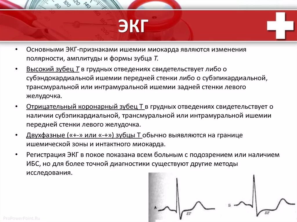 Ишемическая болезнь тест с ответами. Субэндокардиальная ишемия на ЭКГ. ЭКГ при ишемическом повреждении миокарда. ЭКГ при хронической ишемической болезни сердца. Симптомы ишемии миокарда на ЭКГ.