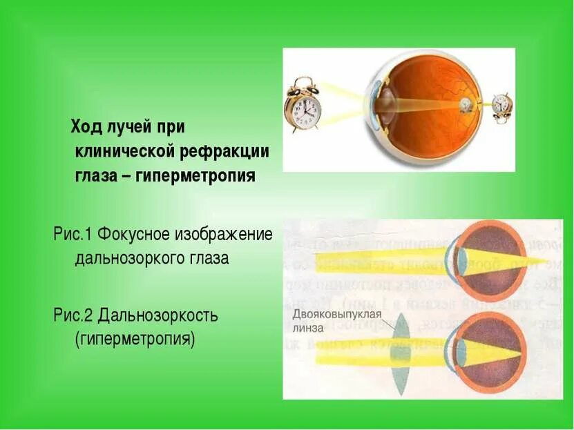 Дальнозоркость линзы двояковыпуклые. Ход лучей в гиперметропическом глазу. Рефракция. Аномалии рефракции глаза. Рефракция фото.