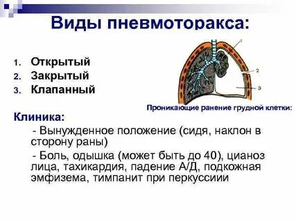 Понятие пневмоторакса
