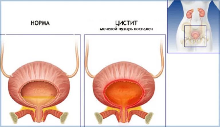 Сильные боли в мочевом. Цстти. Женский цистит.