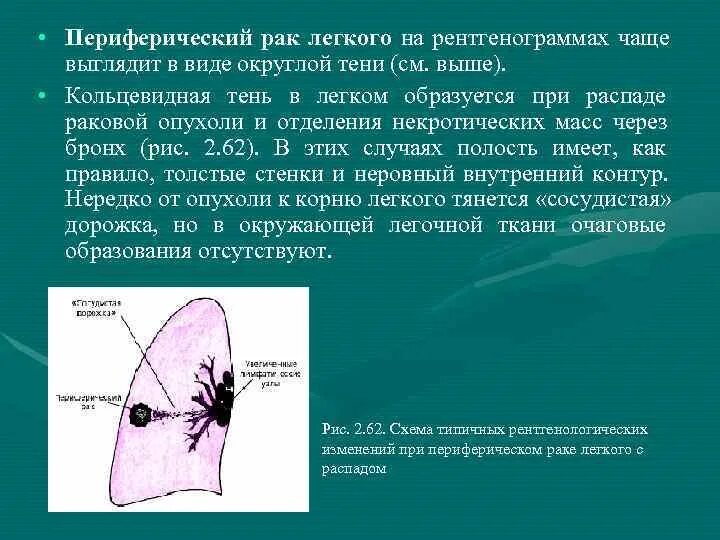 Распадающиеся опухоли легких. Рентгенологические признаки центральноогорака легкого. Кольцевидная тень в легком рентгенологический признак чего. Периферическая раковая опухоль легких. Признаки периферического легкого