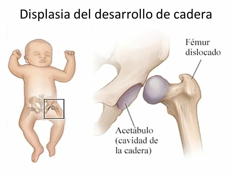 Дисплазия сустава у новорожденного лечение
