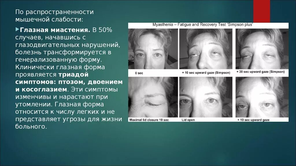 Болезнь глаза птоз верхнего века. Внутриядерная офтальмоплегия это. Аутоиммунная миастения. Миастения глазодвигательного нерва. Спастический блефароспазм.