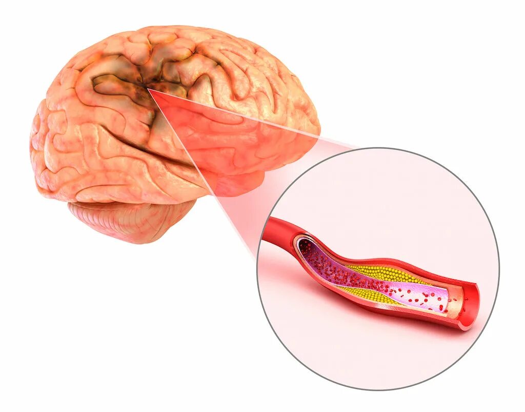 Ишемическая болезнь сосудов. Атеросклероз артерий головного мозга. Атеросклеротическое поражение сосудов головного мозга. Атеросклероз церебральных сосудов. Признак атеросклероза артерий головного мозга.