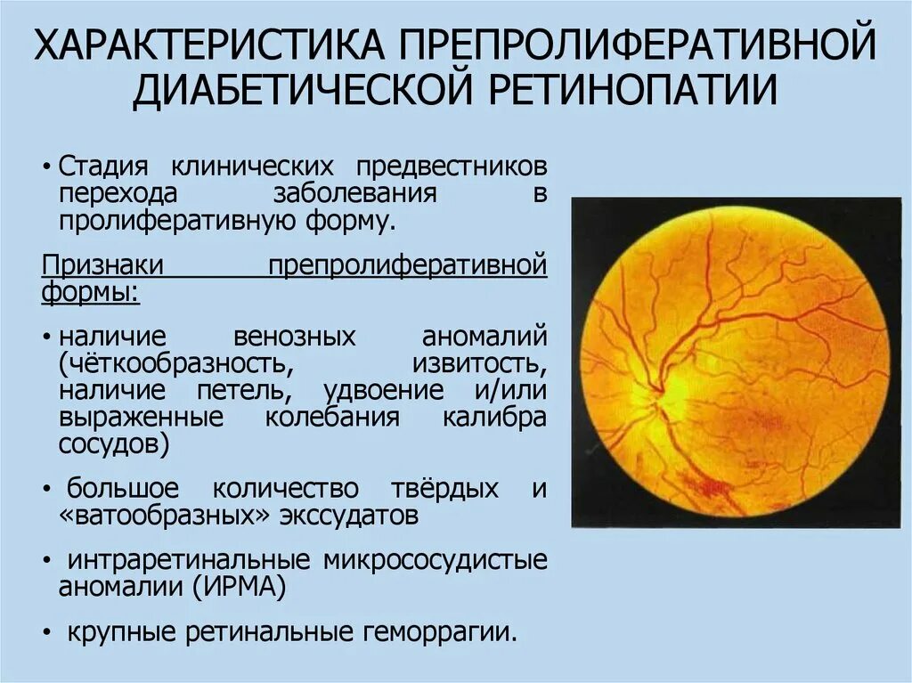 Катаракта при диабете 2 типа