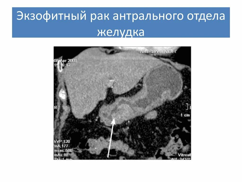 Экзофитные опухоли желудка кт. Образование антрального отдела желудка на кт. Опухоль антрального отдела желудка. Опухоль антрального отдела на кт. Язва кт