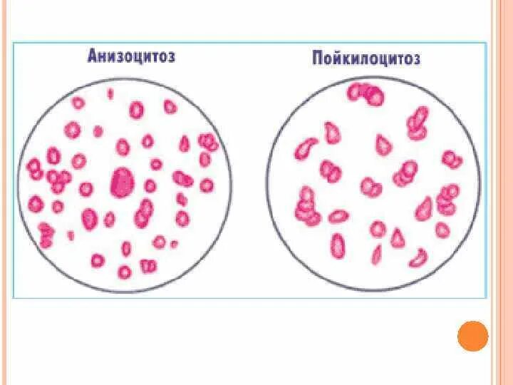 Пойкилоцитоз анемия. Железодефицитная анемия анизоцитоз пойкилоцитоз. Анизоцитоз и пойкилоцитоз эритроцитов. Анизоцитоз микроцитоз. Анизоцитоз и пойкилоцитоз при анемии.