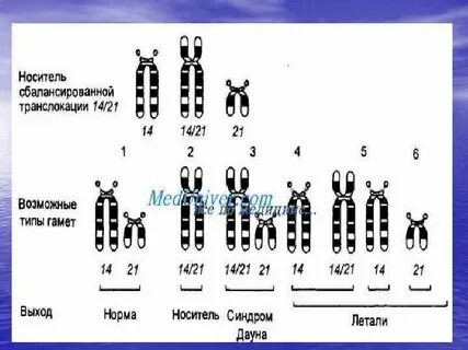 Кариотип транслокации