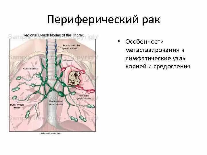 Узлы в легких что это. Схема внутригрудных лимфоузлов. Средостенные лимфатические узлы расположение. Медиастинальные лимфатические узлы увеличены. Лимфатические узлы средостения схема.