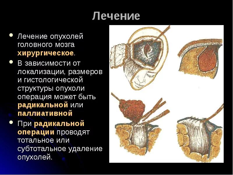 Можно ли вылечить рак мозга. Опухоль головного мозга лечение. оперирование опухолей головного мозга. презентация на тему опухоли.