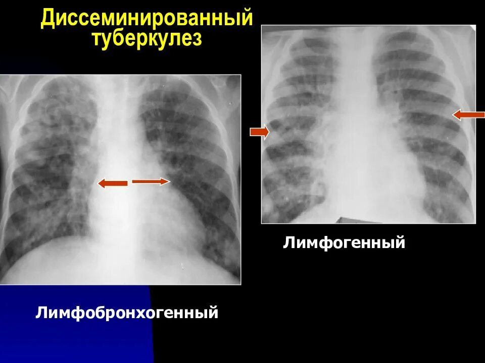 Лимфогенный туберкулез. Лимфогенно диссеминированный туберкулез рентген. Подострый диссеминированный туберкулез рентген. Лимфогенный диссеминированный туберкулез. Лимфогенно диссеминированный туберкулез кт.