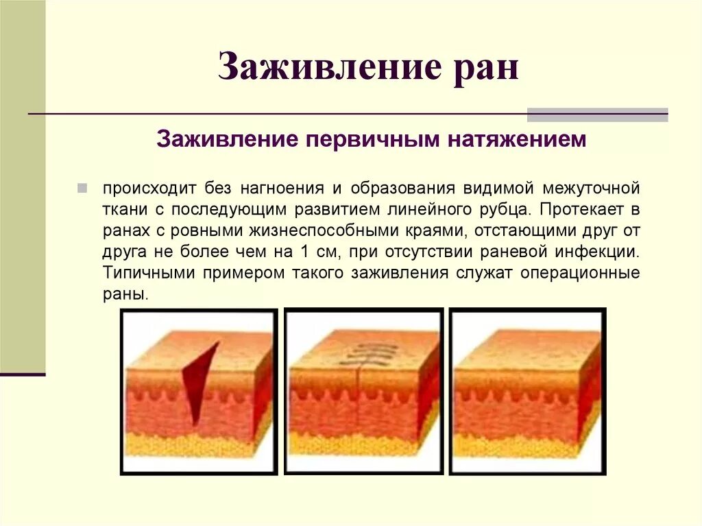 Заживление фото. Заживления первичный натчжением. Заживление РАН первичным и вторичным натяжением. Заживление РАН первычным натяжение. Заживление РАН хирургия вторичная натяжение.
