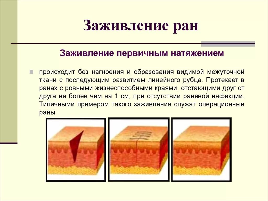 Сколько заживает глубокий. Первичное и вторичное натяжение заживление РАН. Заживление раны первичным натяжением. Заживление РАН вторичным натяжением рубцы. Морфология заживления РАН первичным и вторичным натяжением.