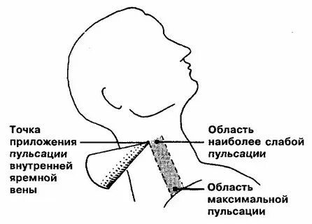 Шум волчка на яремных
