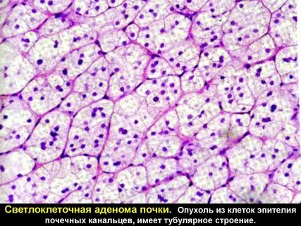 Светлоклеточный почечный