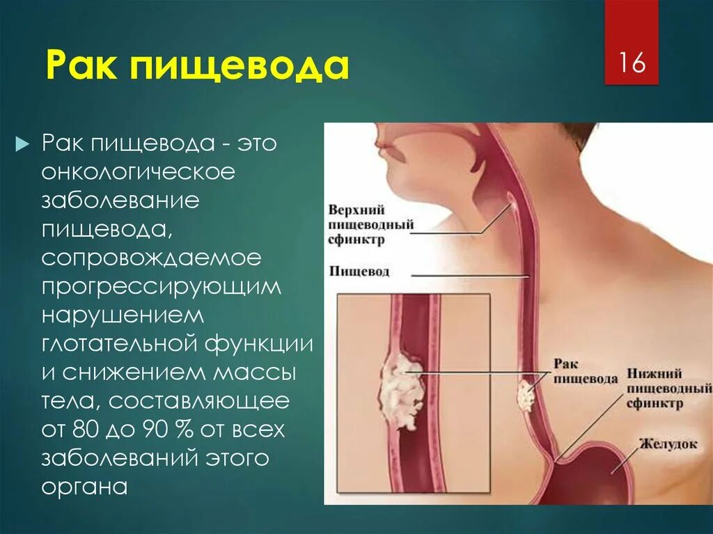 Злокачественные заболевания пищевода. Опухоль средней трети пищевода. Основные симптомы заболевания пищевода. Операция пищевода лечение