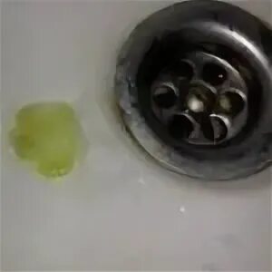 Кашель с зеленой мокротой