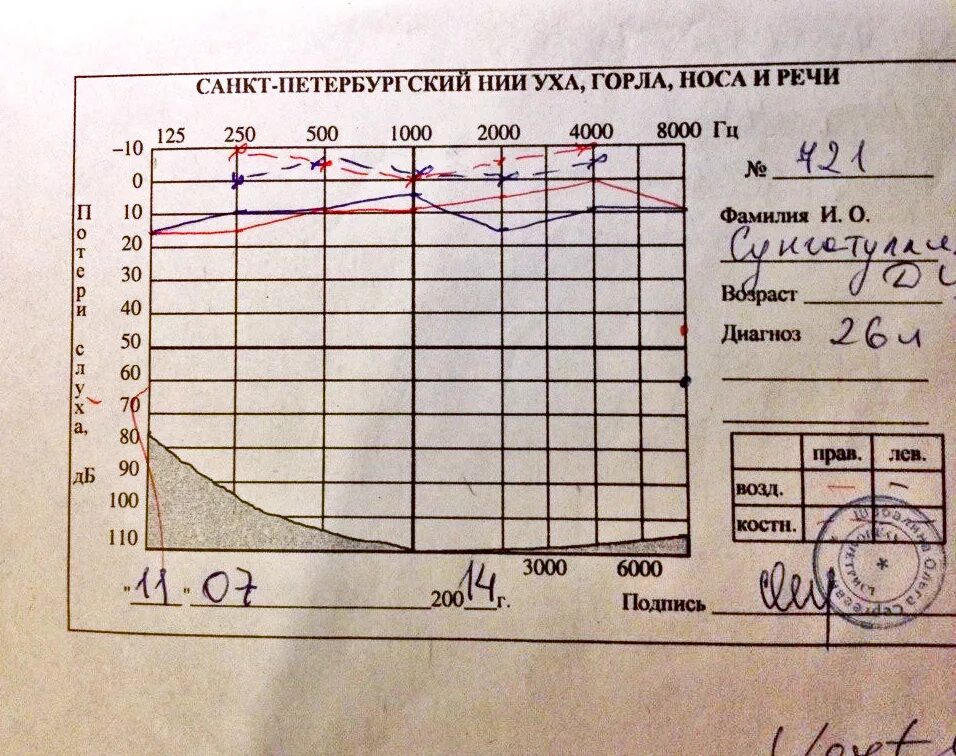 Аудиограмма в спб. Аудиограмма слуха норма. Аудиограмма здорового человека норма. Тональная пороговая аудиограмма норма. Тональная пороговая аудиометрия норма заключение.