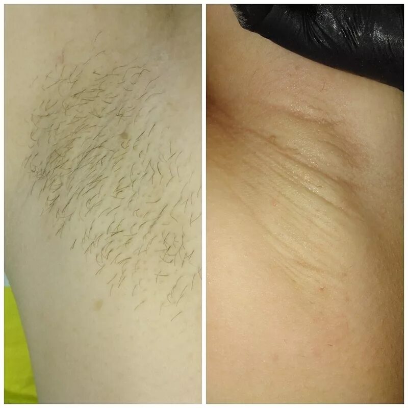 Шугаринг зоны бикини. Шугаринг глубокое бикини сама себе. Депиляция шугаринг бикини. Шугаринг глубокое бикини сама себе. Лазерная эпиляция глубокое бикини.