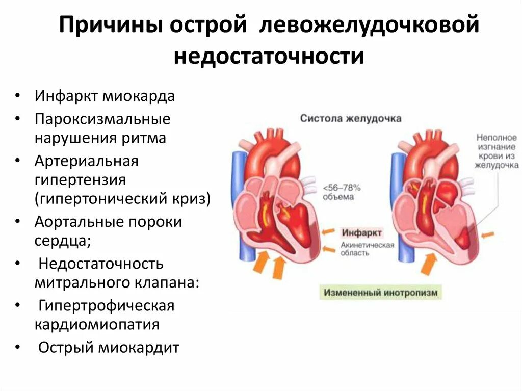 Наиболее частая причина сердечной недостаточности. Проявления синдрома острой сердечной недостаточности. Причины развития острой сердечной недостаточности. Симптомы острой левожелудочковой сердечной недостаточности. Причины острой левожелудочковой недостаточности.