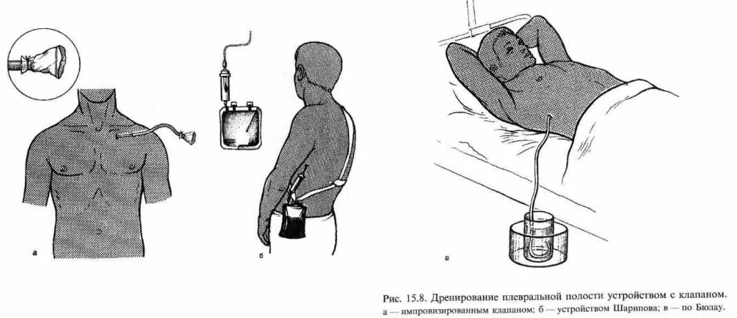 Дренирование полости по Бюлау. Пассивное дренирование Бюлау. Дренирование при напряженном пневмотораксе. Дренирование при гемотораксе. Наличие крови в плевральной полости