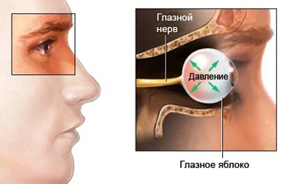 Глазное давление боль. Воспаление глазного нерва. Неврит глазного нерва симптомы. Снижение внутриглазного давления.