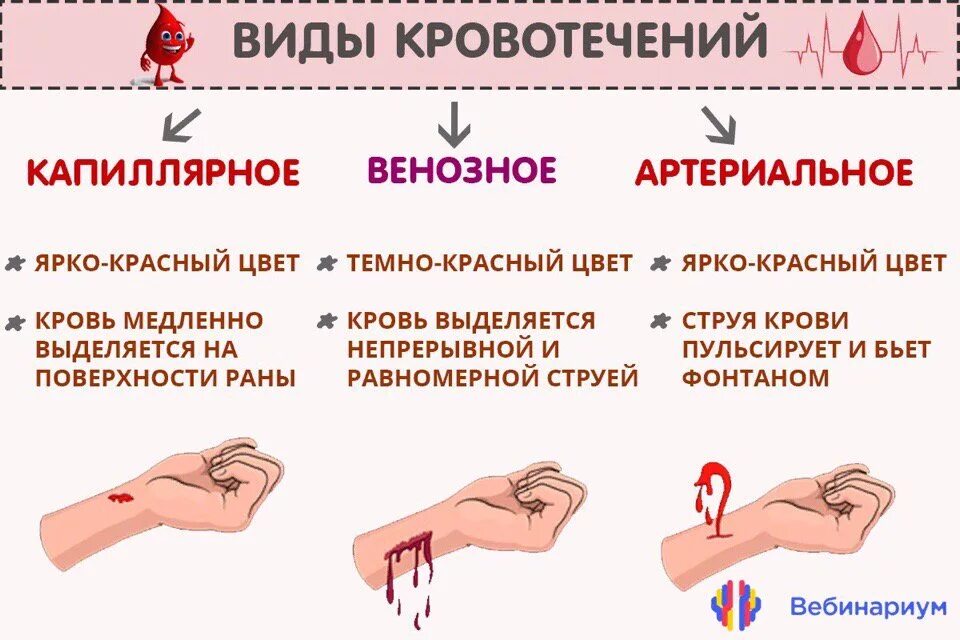 Типы внутренних кровотечений. Артериальное венозное и капиллярное кровотечение. Виды кровотечений венозное капиллярное артериальное внутреннее. Типы внешних кровотечений. Крови в легкой форме