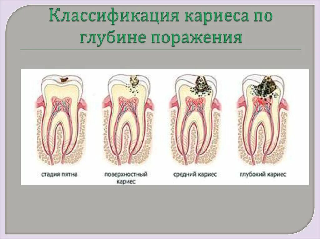 Классификация поражений зубов