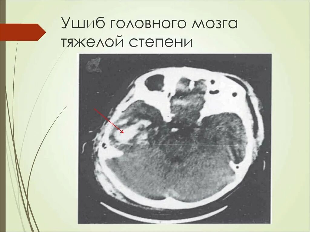 Закрытые повреждения мозга. Ушиб головного мозга тяжелой степени. Ушиб головного мозга средней степени тяжести кт. Ушиб головного мозга кт степени. Ушиб головного мозга средней степени кт.