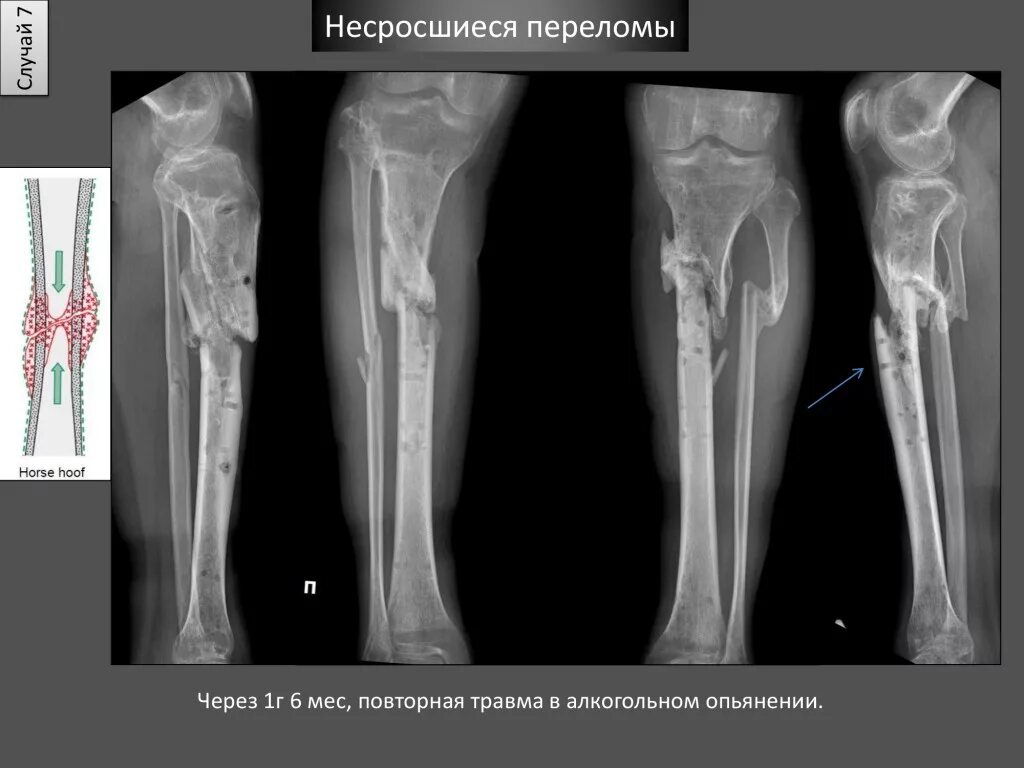 Что такое консолидация перелома. Ложный сустав берцовой кости. Замедленная консолидация большеберцовой кости. Замедленная консолидация переломов рентген. Ложный сустав большеберцовой кости.