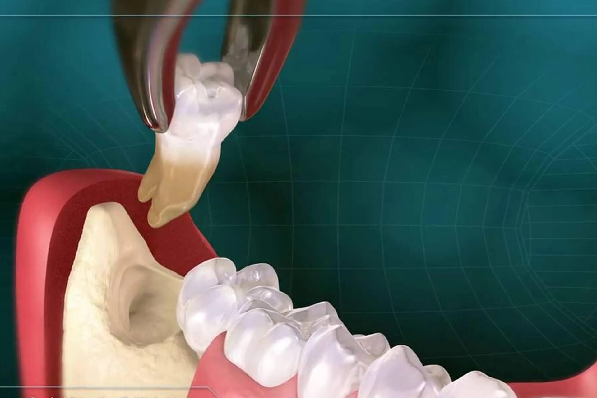Зуб 8 нижний. Альвеолит стоматология. Альвеолит хирургическая стоматология. Альвеолит лунки мудрости.