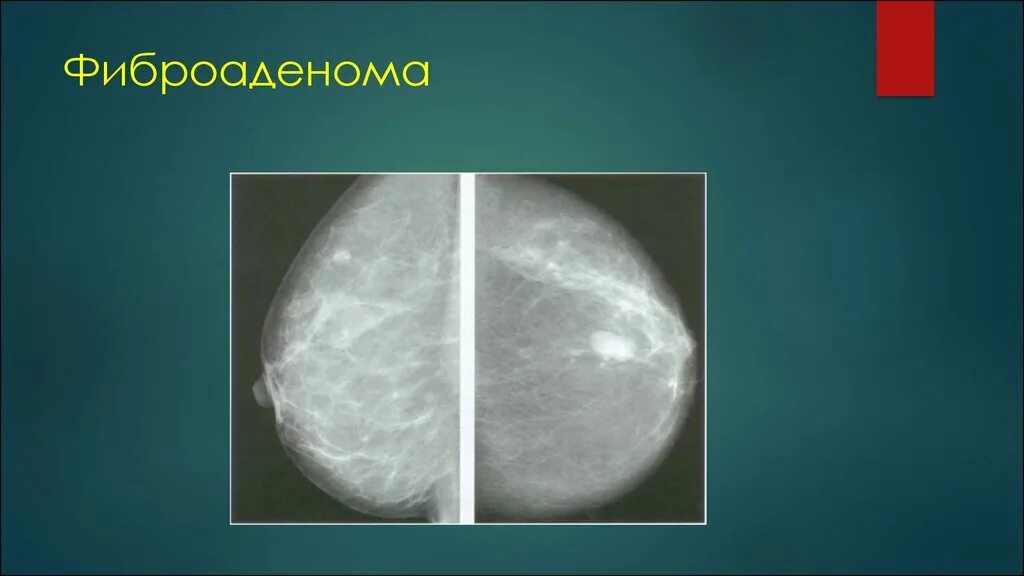 Фиброаденоматоз bi. Фиброаденоматоз молочной железы рентген. Фиброаденома молочной железы рентген. Фиброзно кистозная мастопатия маммограмма. Листовидная фиброаденома рентген.