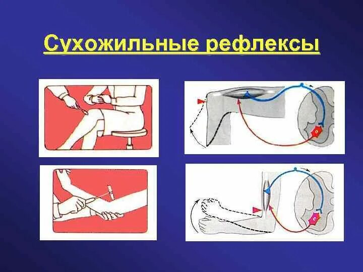 Рефлексы верхних конечностей. Сухожильные рефлексы. Исследование сухожильных рефлексов. Исследование сухожильных рефлексов у человека. Методика исследования сухожильных рефлексов.