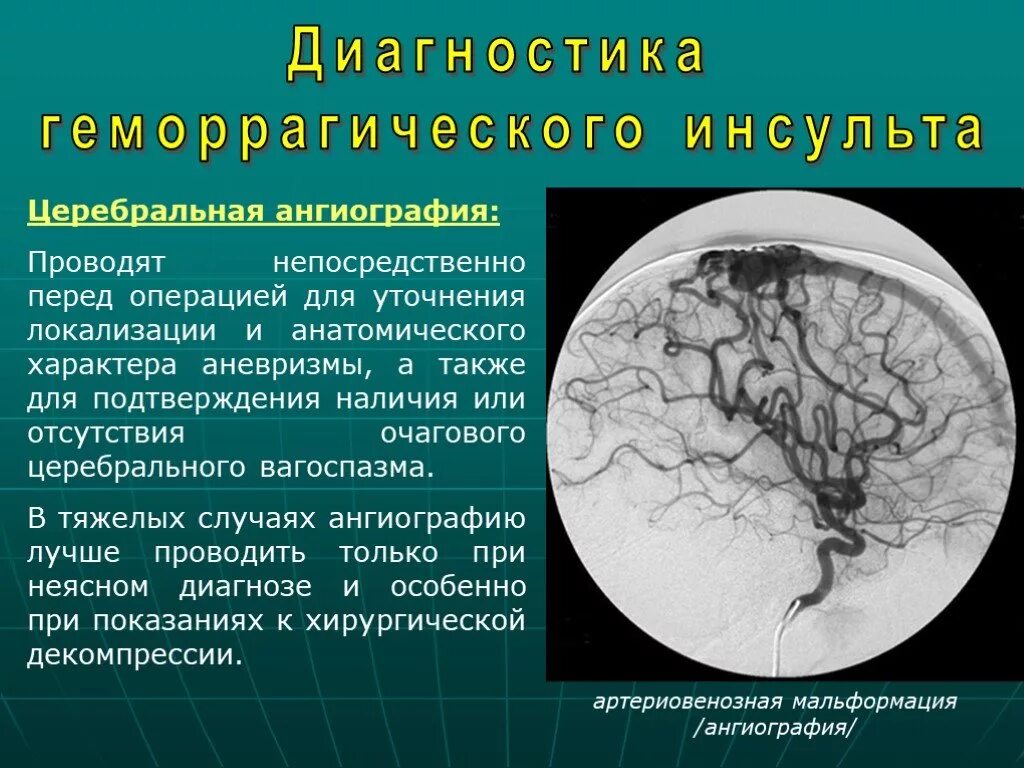 Инсульт геморрагический правая. Геморрагический инсульт по локализации. Церебральная ангиография при геморрагическом инсульте. Презентация на тему геморрагический инсульт. Локализация поражения при геморрагическом инсульте.