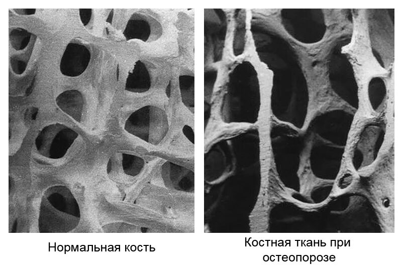 В костях и т д. Костная ткань остеопороз. Нормальная кость и кость при остеопорозе. Костная ткань в норме и остеопороз. Разряжение костной ткани.