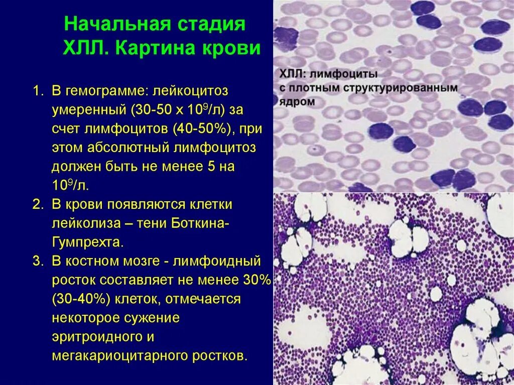 Клетки лейколиза (тени Боткина-Гумпрехта). Хронический лимфолейкоз клетки Боткина. Тельца Боткина Гумпрехта. Клетки Боткина Гумпрехта это. Хронический лимфолейкоз кровь