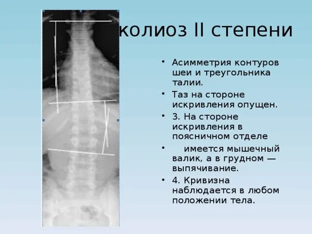 Сколиоз 2 степени это. Мышечные валики при сколиозе. Мышечный валик при сколиозе. Сколиоз 2 степени армия. Как выглядит сколиоз 2 степени 17 градусов.