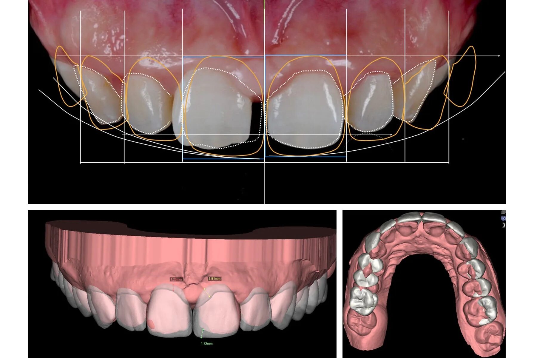 Операция реплантации зуба. Планировании стоматологической имплантации. Хирургический шаблон в стоматологии. Программа dsd (digital smile design). Планировала зуба.