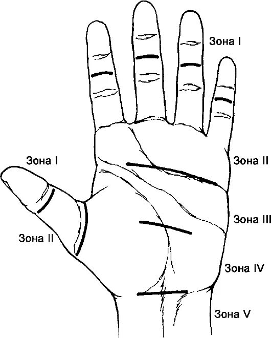 критическая зона кисти. зоны повреждения сухожилий разгибателей кисти. ничейная зона кисти. рефлексогенные зоны на ладони. 5 зон кисти травматология.