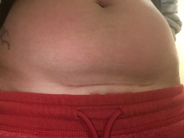 Шрам после кесарева сечения. Косметический шов кесарева сечения. Шрам от кесарева сечения. Живот после кесоревосечения. Обезболивающее после кс.