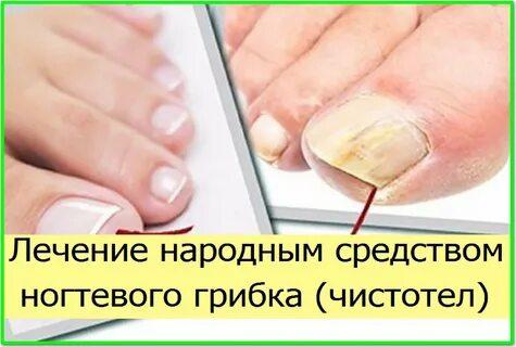 Грибок ногтей народные способы