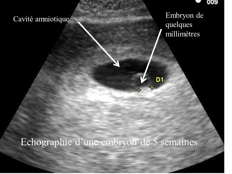 УЗИ 6 недель беременности желточный мешок. УЗИ желточный мешок 5 неделя. Внематочная 5 недель
