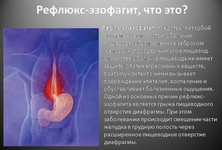 Рефлекс эзофагит. Неэрозивный рефлюкс эзофагит. десквамативный эзофагит. гастрит рефлюкс эзофагит. постваготомический рефлюкс эзофагит.
