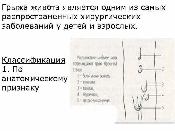 Симптомы грыжи живота у женщин слева. Вентральные грыжи живота классификация. Классификация грыж передней брюшной. Грыжи брюшной полости классификация. Классификация грыж передней брюшной стенки классификация.