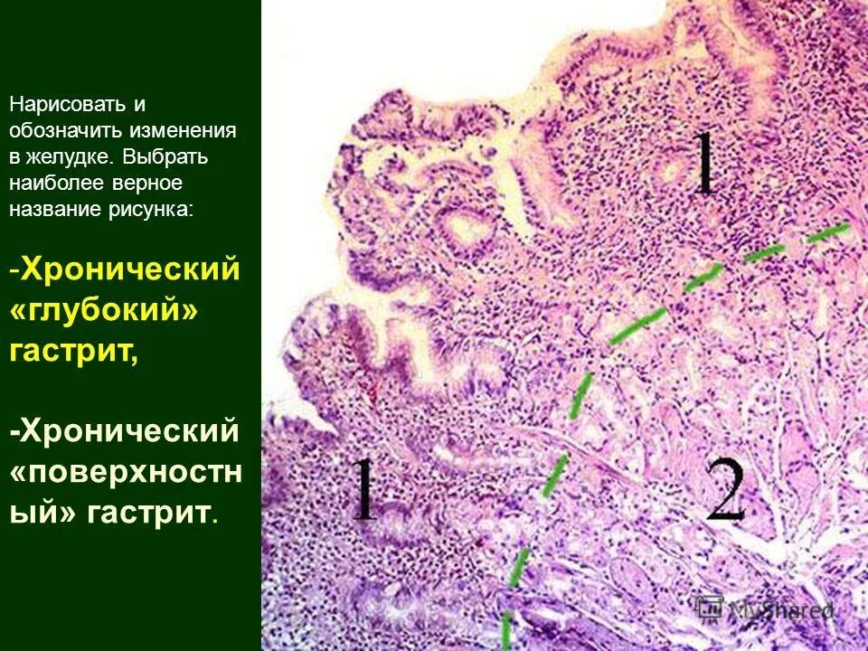 Язва микропрепарат