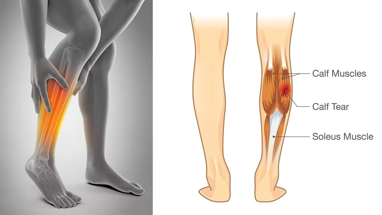Почему ноги напряжены. Судорога икроножной мышцы. Судороги в ногах икроножные мышцы. Спазм мышц икроножной мышцы.