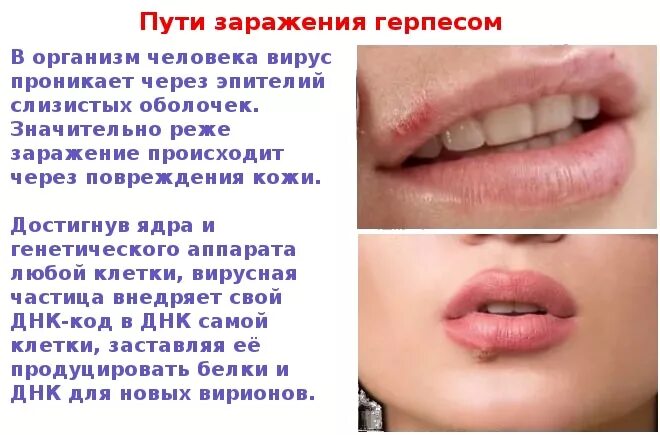 Как быстро снять отек герпес ТОП-8 мифов о герпесе разбираем с врачами Evolutis Clinic Дзен