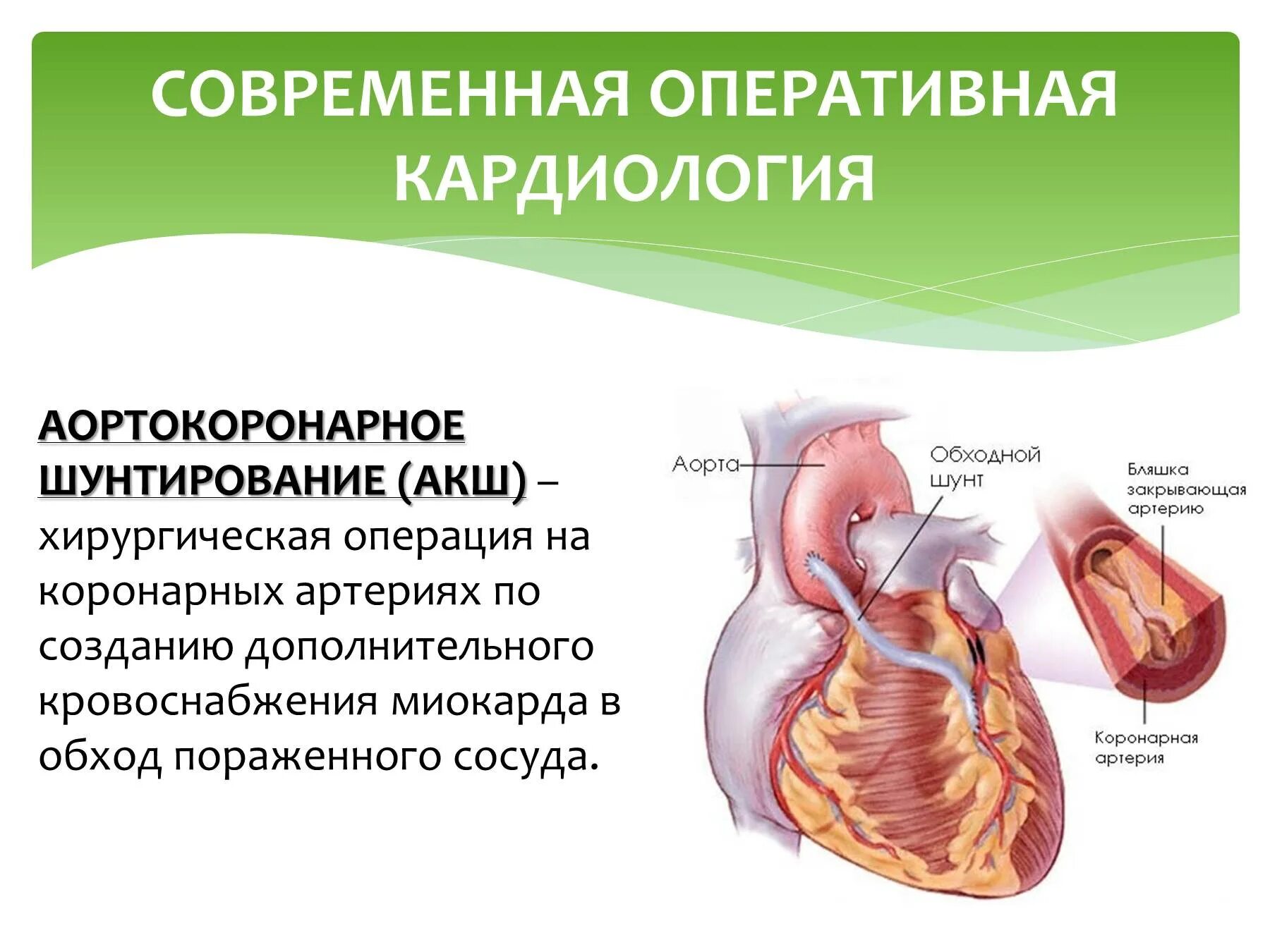 Операции коронарных артерий. Инфаркт миокарда операция шунтирование. Хирургические методы лечения инфаркта миокарда. Аорто-коронарное шунтирован. Современная Оперативная кардиология.