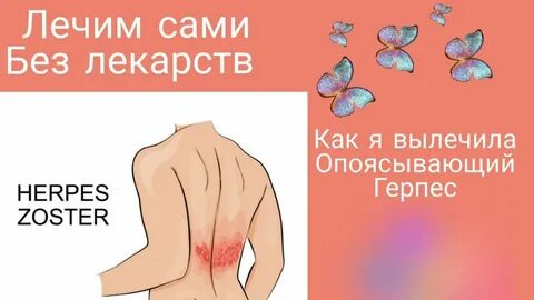 Опоясывающий герпес психосоматика