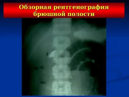 Спаечная болезнь брюшной полости